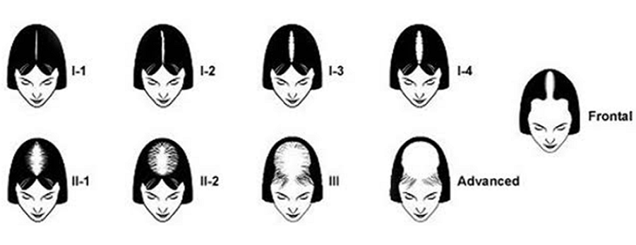 Best Hair Loss Treatment for Female