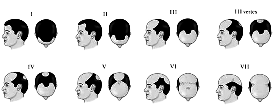 Hair Loss Treatment for Men