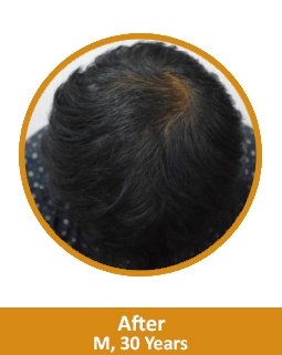 After Hair Loss Treatment In India