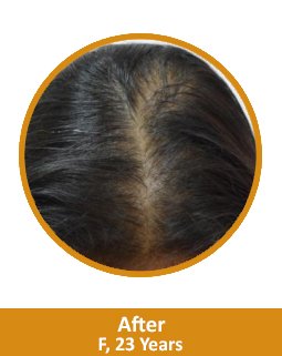 After Hair Loss Treatment for Female
