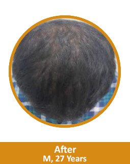 After GFC Treatment for Hair
