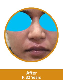 After Best SkIn Treatment In India