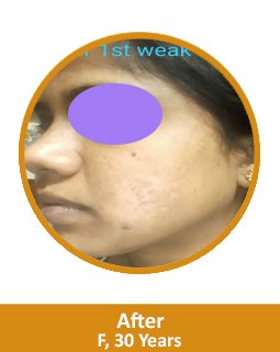 After GFC Face Treatment