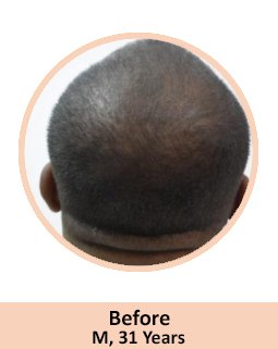 Before Baldness Treatment In India