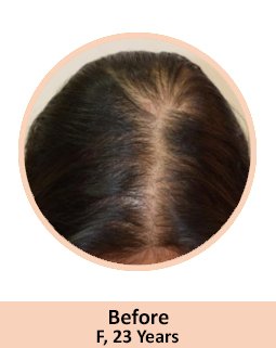 Before Hair Loss Treatment