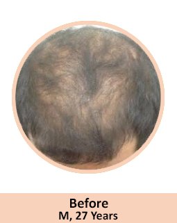 Before Gfc Hair Treatment