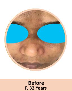 Before GFC Treatment for face