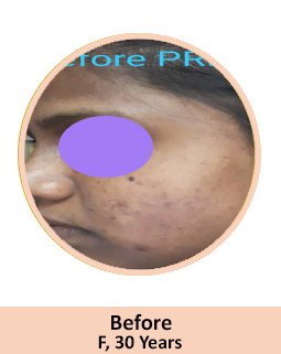 Before GFC Skin Treatment