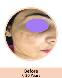 Before GFC face Treatment